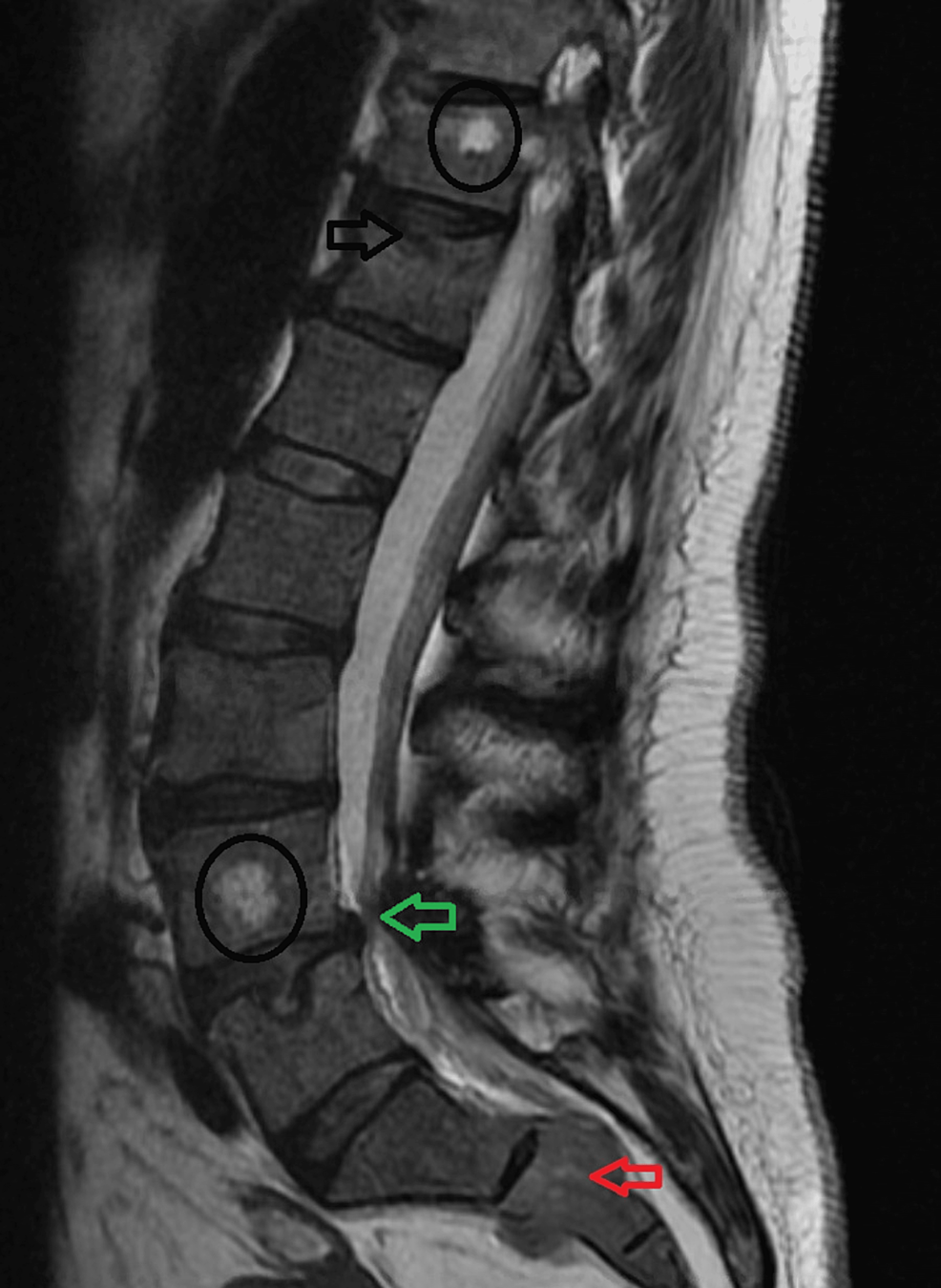 A Case Of Plasmablastic Multiple Myeloma With Extramedullary Disease ...