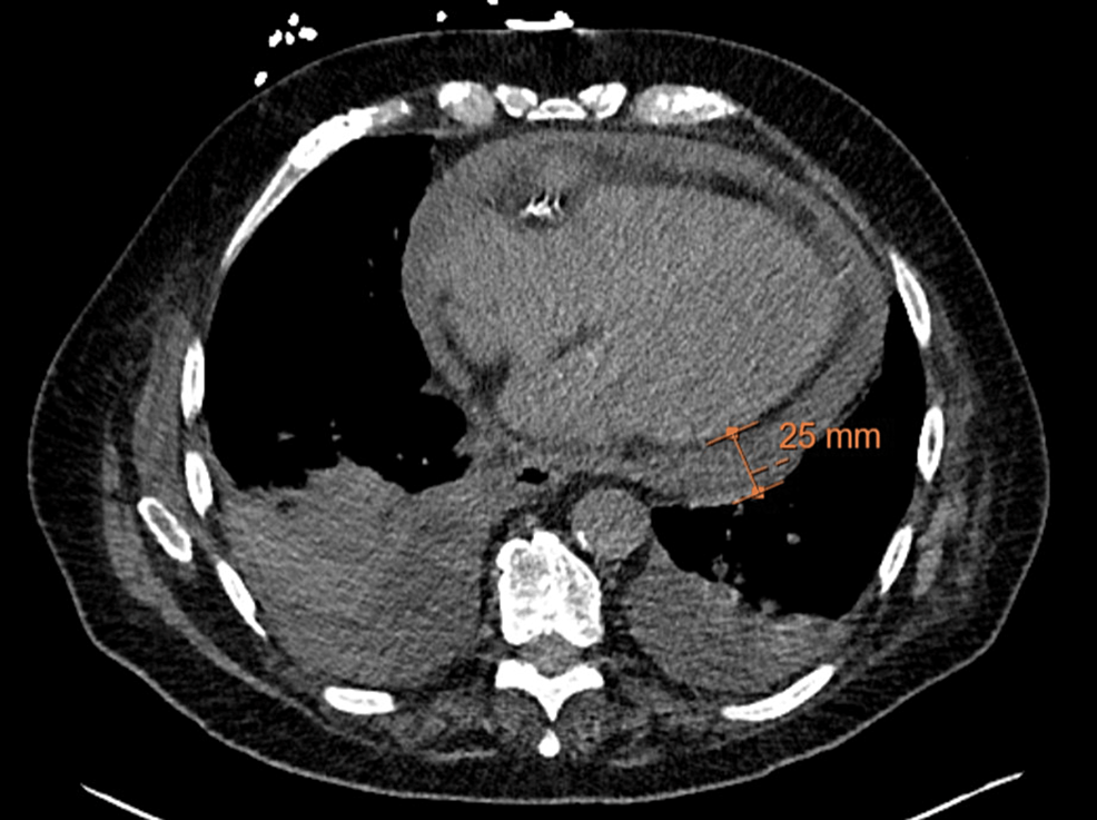 CT-chest-axial-view-demonstrating-a-moderate-to-large-pericardial-effusion-and-bilateral-pleural-effusions