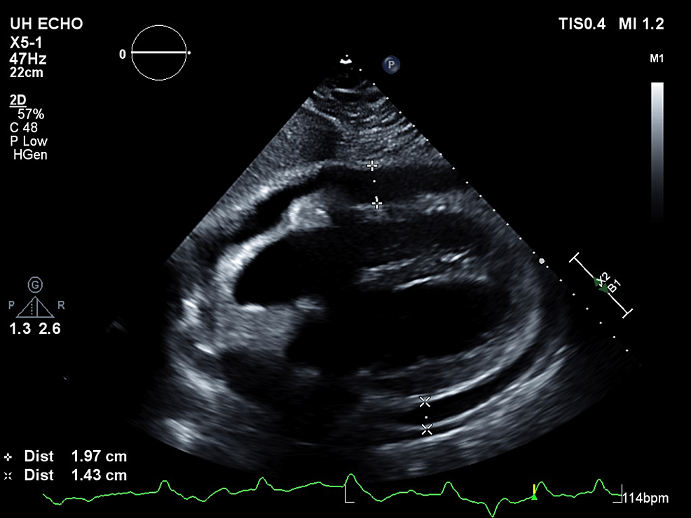 2-D-echocardiographic-parasternal-long-axis-view-of-the-heart-with-moderate-to-large-circumferential-pericardial-effusion-resulting-in-the-beginnings-of-right-ventricular-collapse-consistent-with-early-cardiac-tamponade-physiology