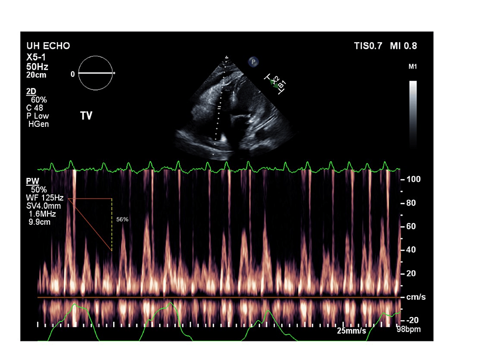 Continuous-Doppler-study-showing-the-respiratory-variation-in-tricuspid-inflow-velocity-of-56%