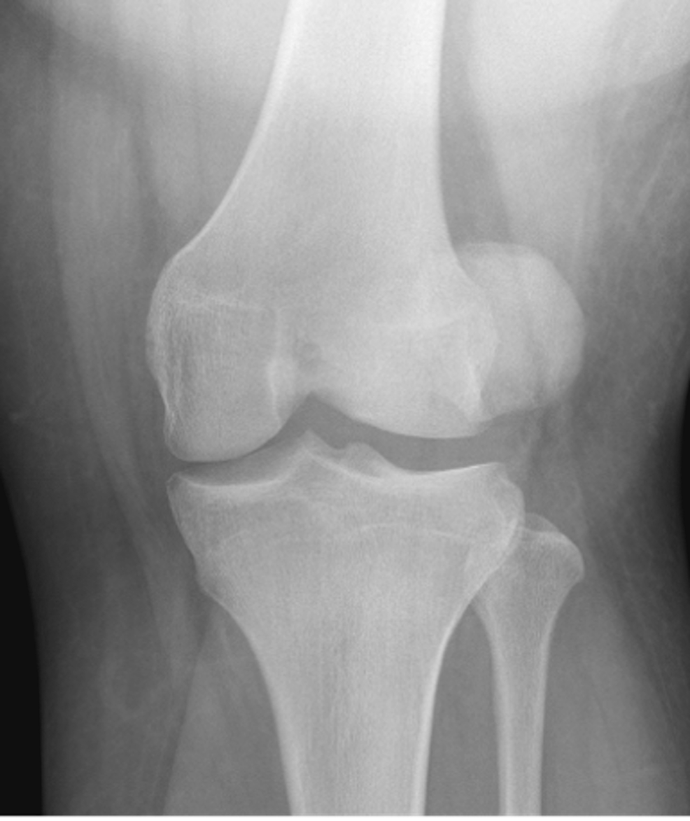 knee patellar dislocation x ray
