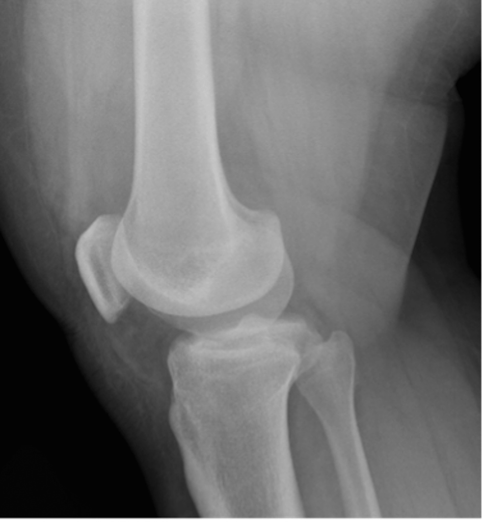 Cureus Efficient Recognition and Closed Reduction of Locked Lateral