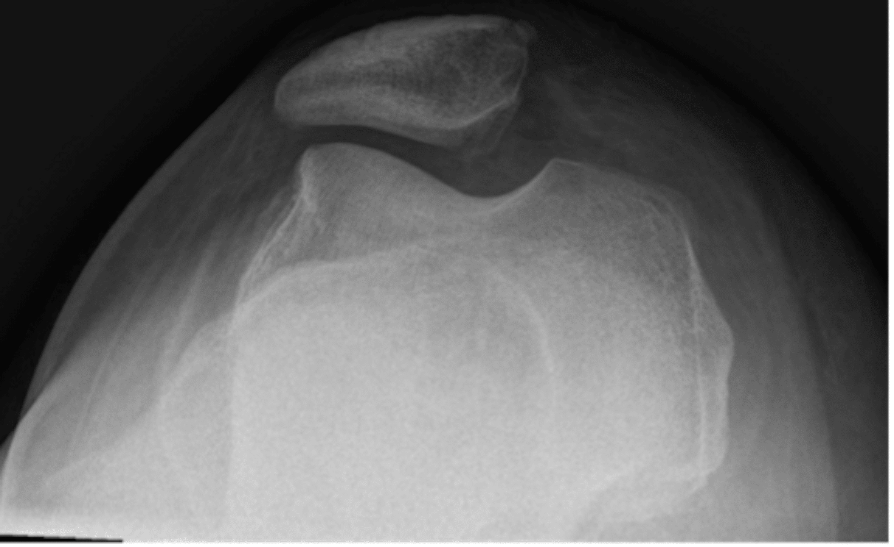 Cureus Efficient Recognition and Closed Reduction of Locked Lateral