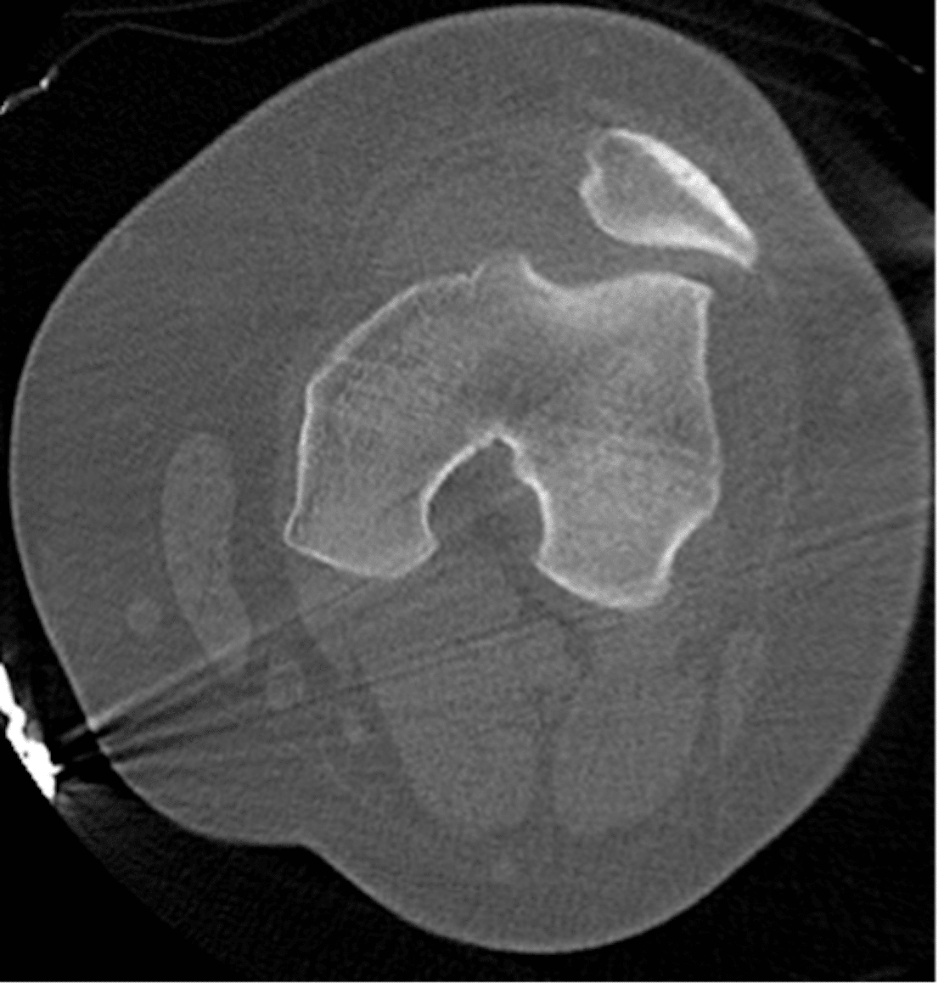 Cureus Efficient Recognition and Closed Reduction of Locked Lateral