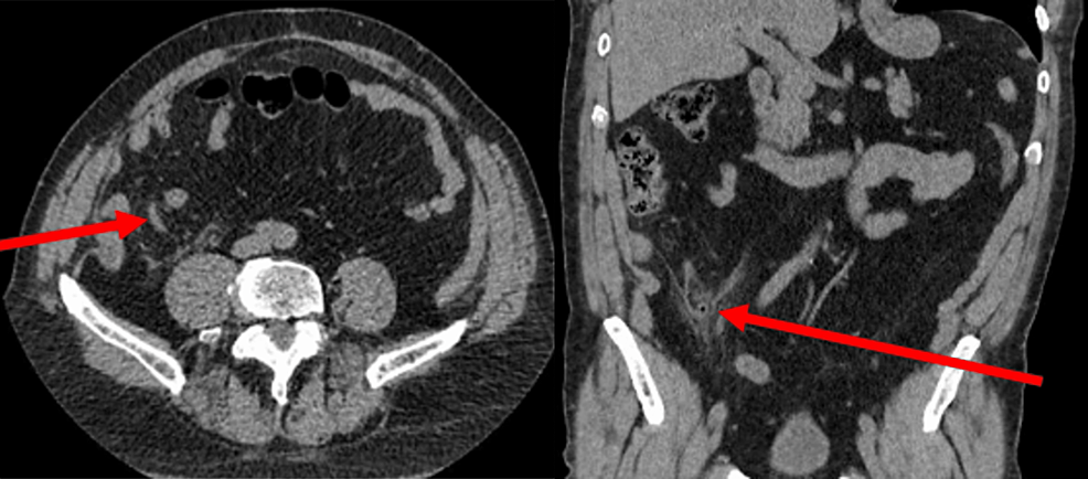 Appendiceal Diverticulitis Presenting As Acute Appendicitis: A Case ...