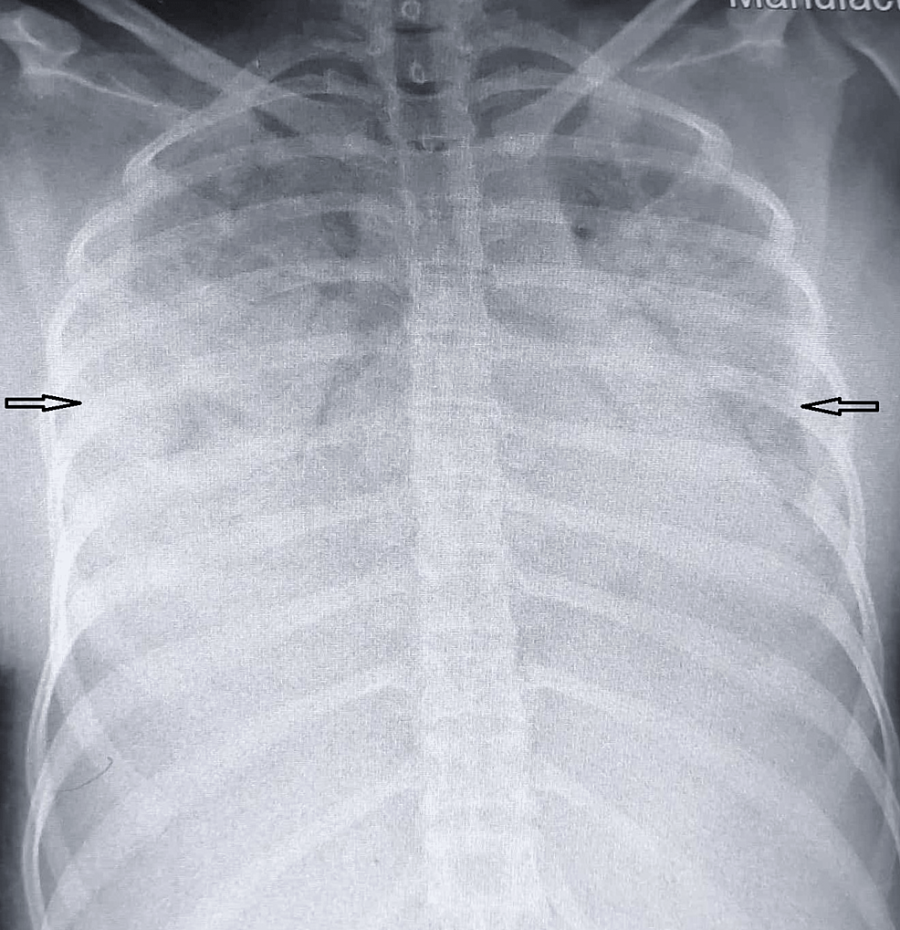 Chest-radiograph-on-admission-showing-bilateral-middle-and-lower-zone-opacities.