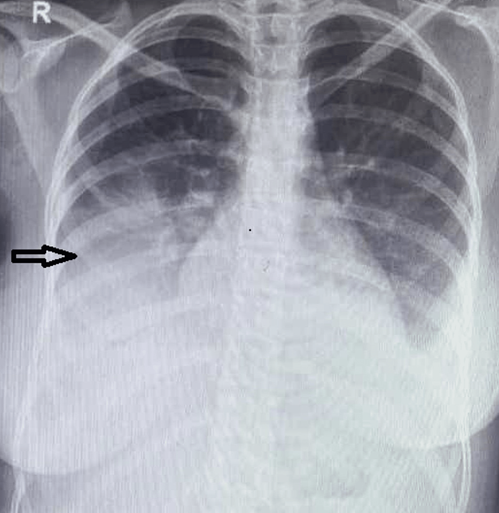 Repeat-chest-radiograph-after-three-days,-showing-significant-improvement-in-the-opacities.