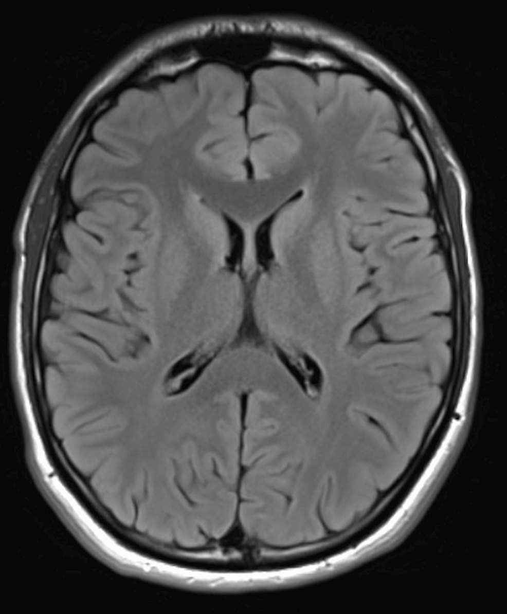 A Rare Case of Lance-Adams Syndrome: Status Post-Successful ...