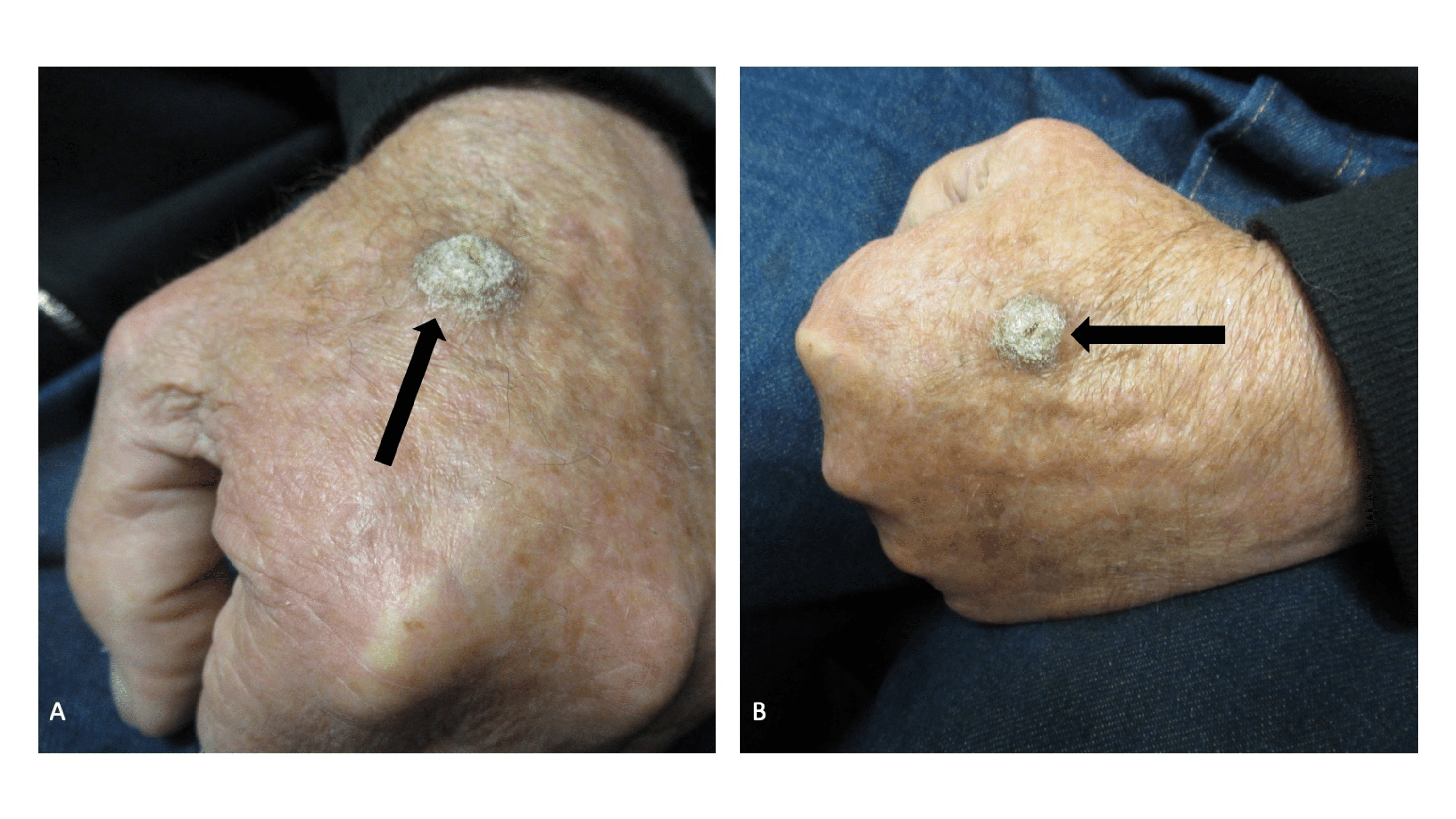 Cureus Cutaneous Squamous Cell Carcinoma Masquerading as a Verruca