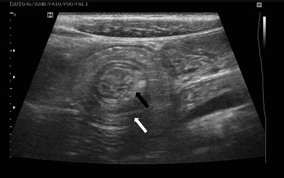 cureus-intestinal-intussusception-due-to-entrapped-ascaris