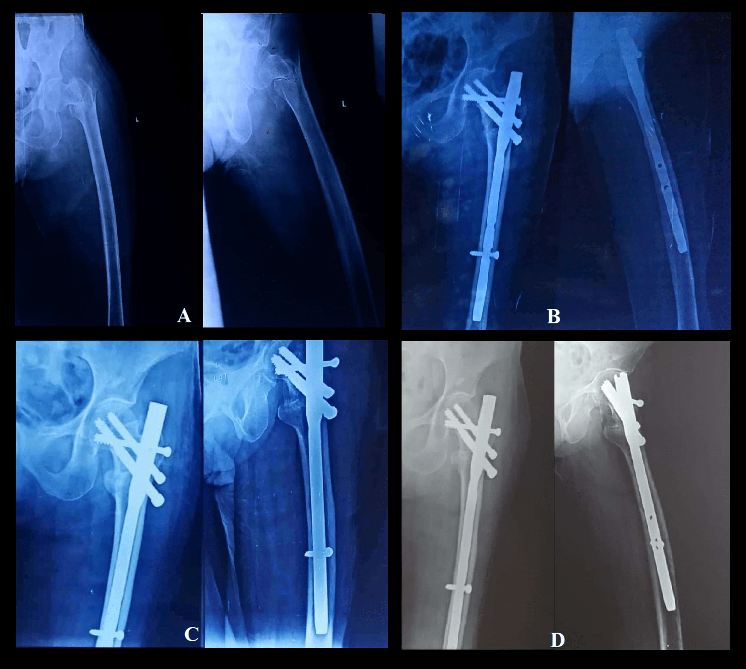 Cureus | Prospective Comparative Study Between Proximal Femoral Nail vs.  Screw Augmented Proximal Femoral Nail in Unstable Intertrochanteric  Fractures of Femur | Article