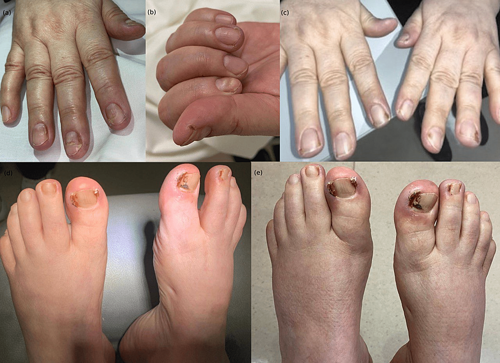 A case of onychomycosis caused by Aspergillus candidus - ScienceDirect
