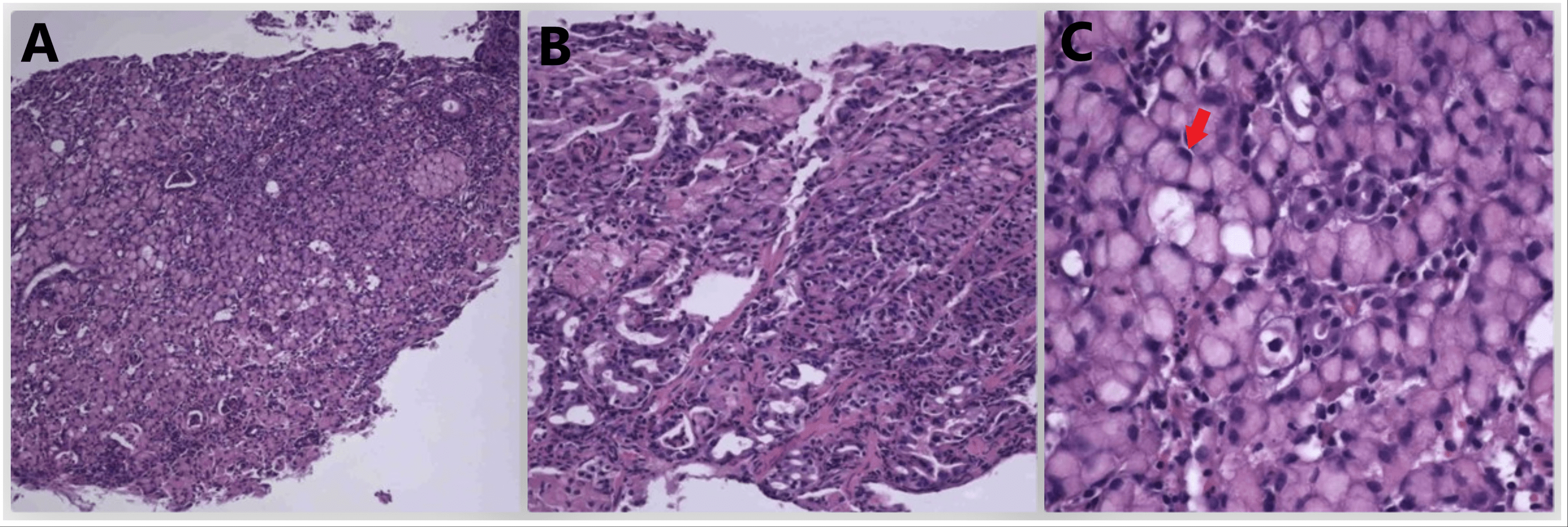 A Rare Case of Metastatic Gastric Ring Cell Adenocarcinoma in a