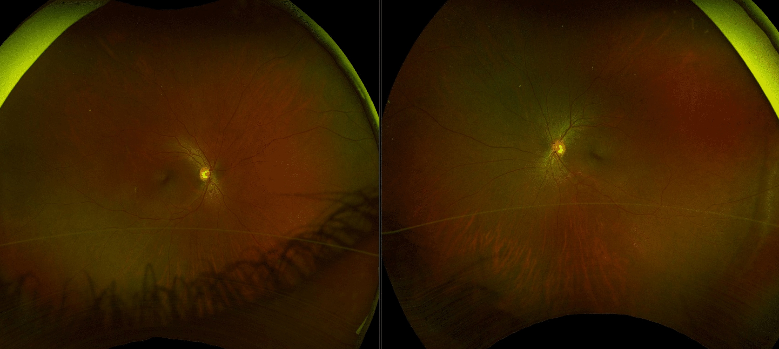 Transient Light Sensitivity After Lasik Shelly Lighting