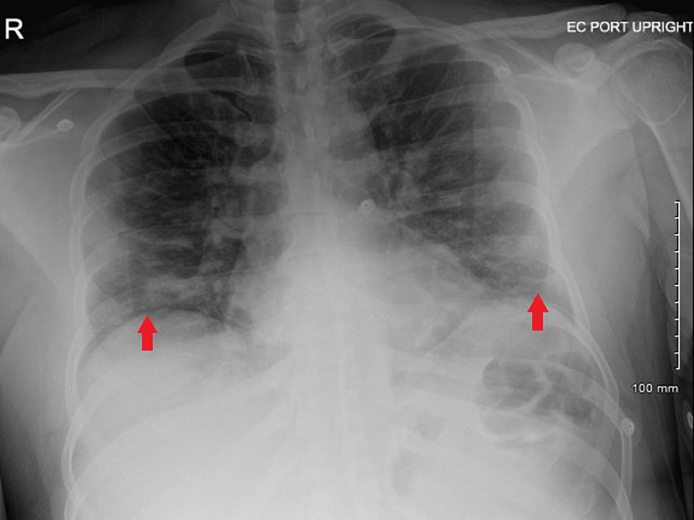 Cureus COVID19 Infection as a Possible Cause of Ogilvie’s Syndrome