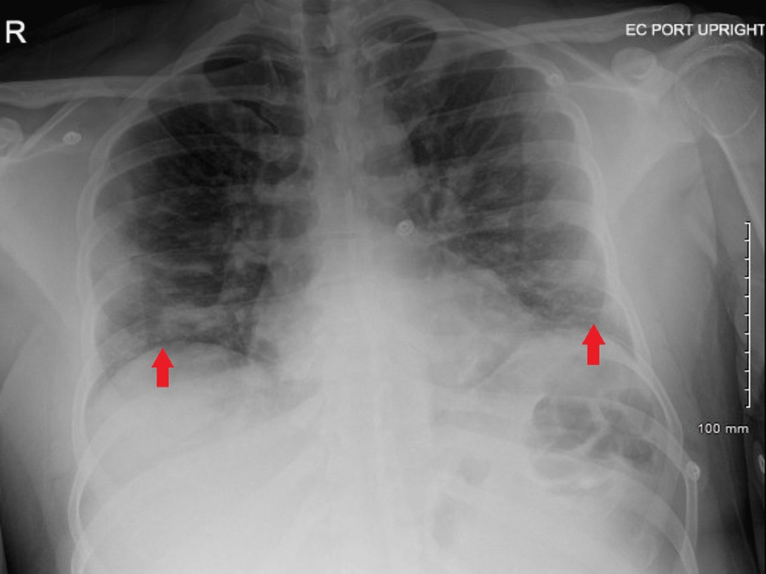 Cureus COVID19 Infection as a Possible Cause of Ogilvie’s Syndrome