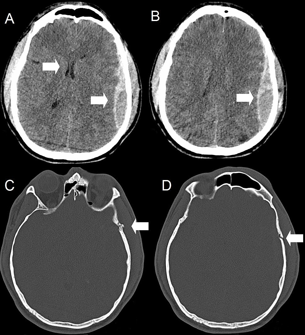 Delayed Rupture of a Cortical Traumatic Intracranial Aneurysm | Cureus