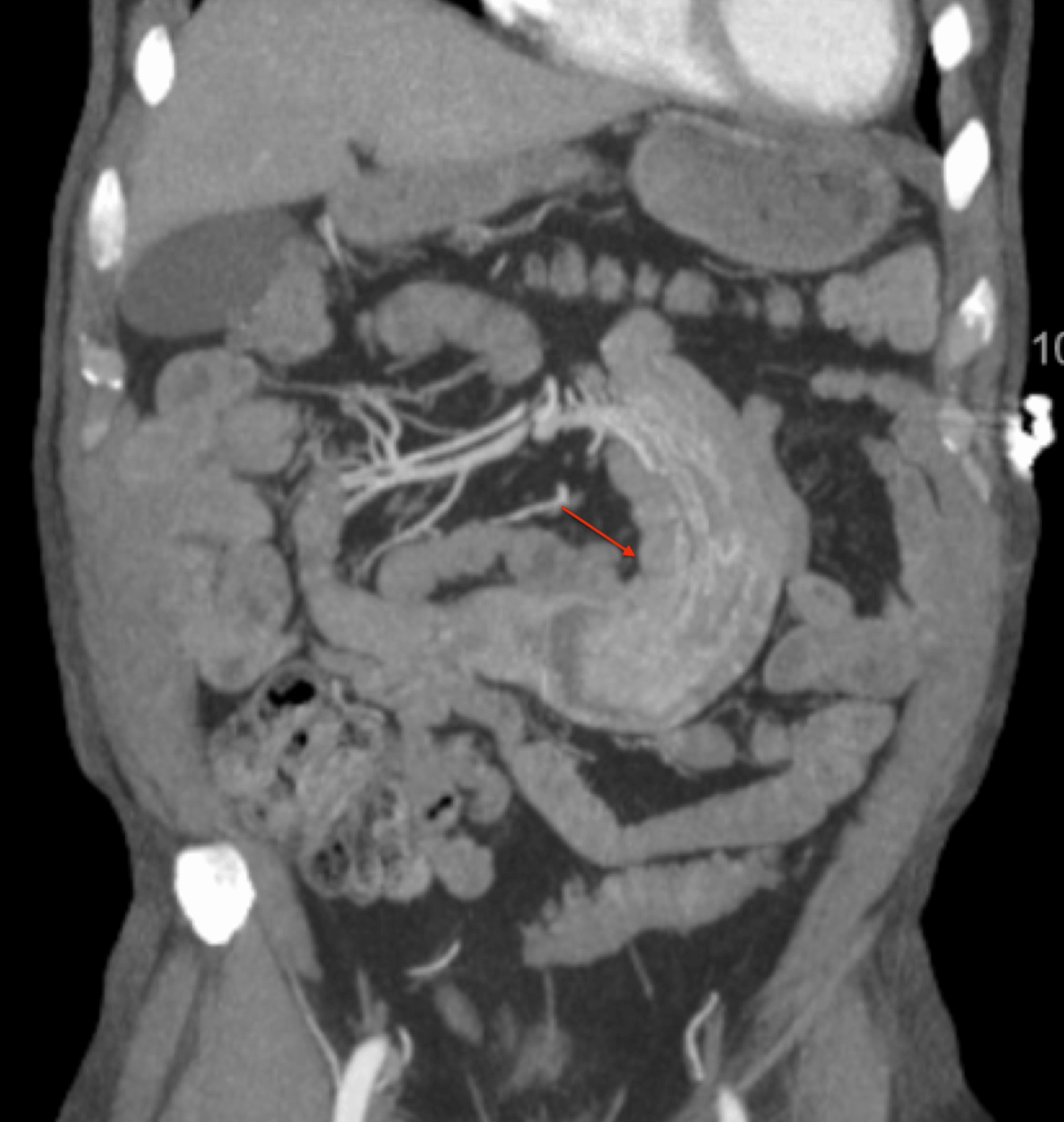 Cureus Metastatic Jejunal Renal Cell Carcinoma Intussusception