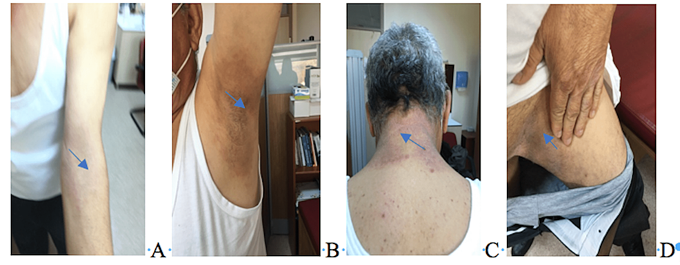 Cureus Amoxicillin Clavulanic Acid Induced Symmetric Drug