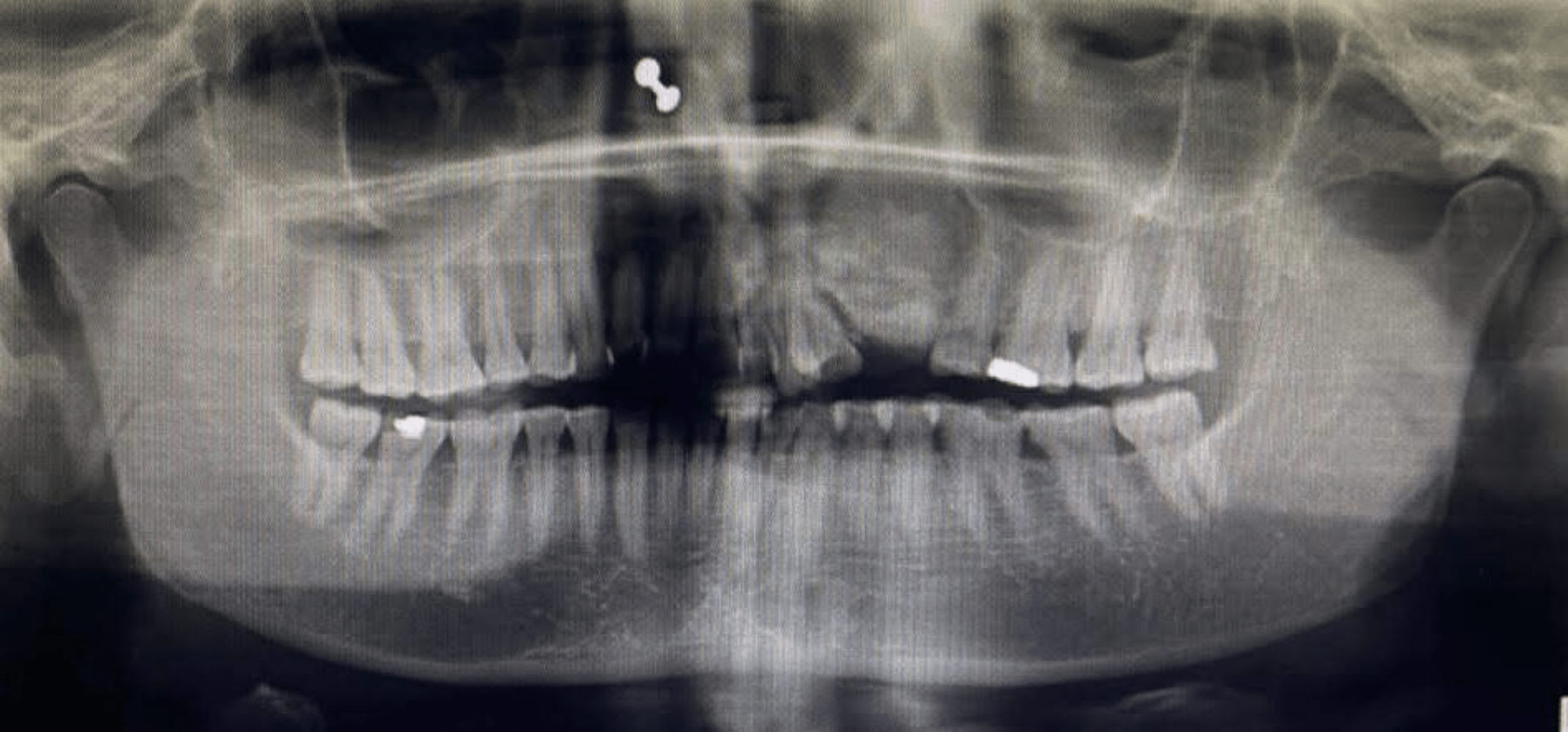 Cureus Enchondroma of Anterior Maxilla A Rare Entity