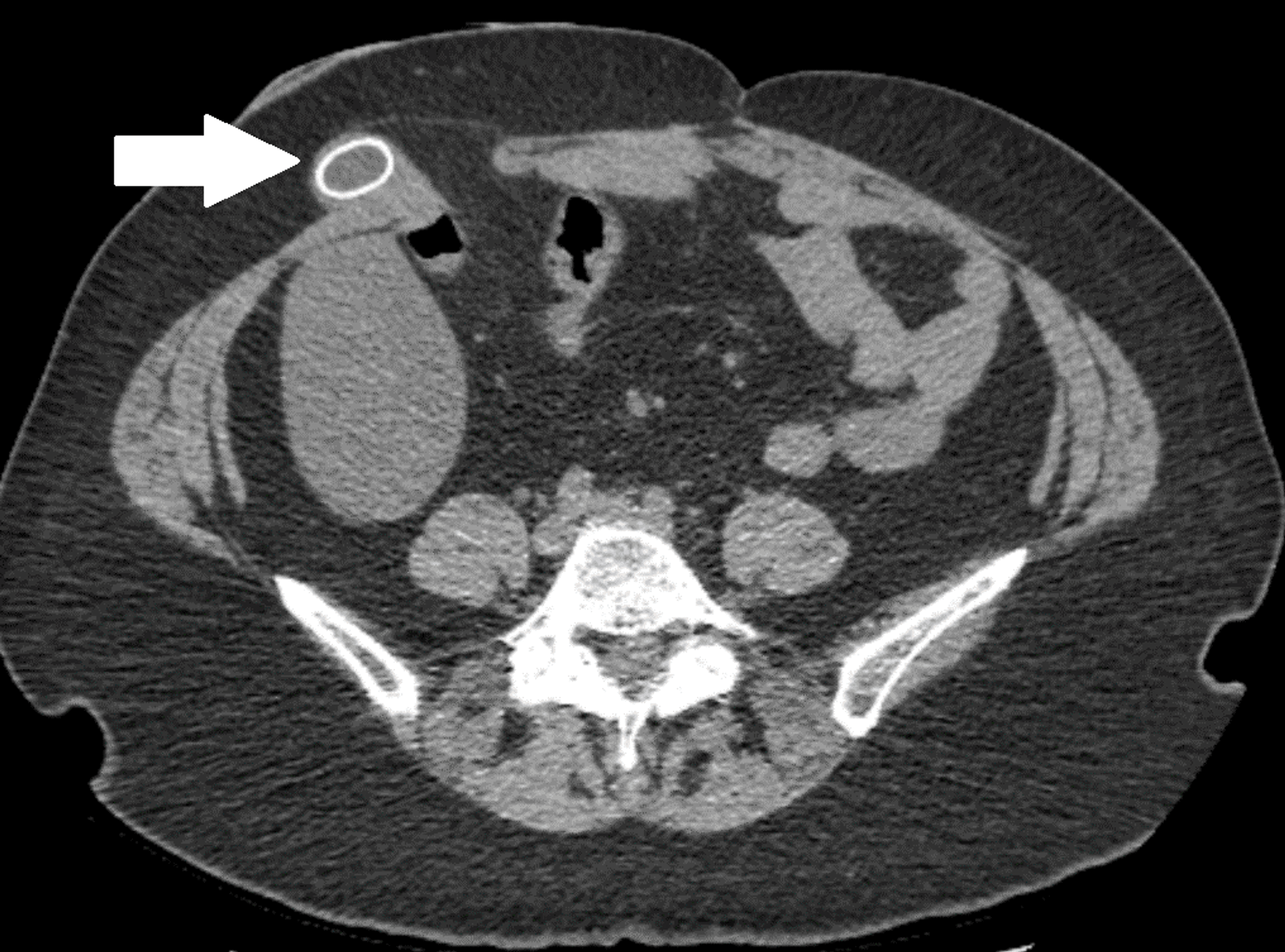 Cureus | Spontaneous Resolution Of Parastomal Gallbladder Herniation ...