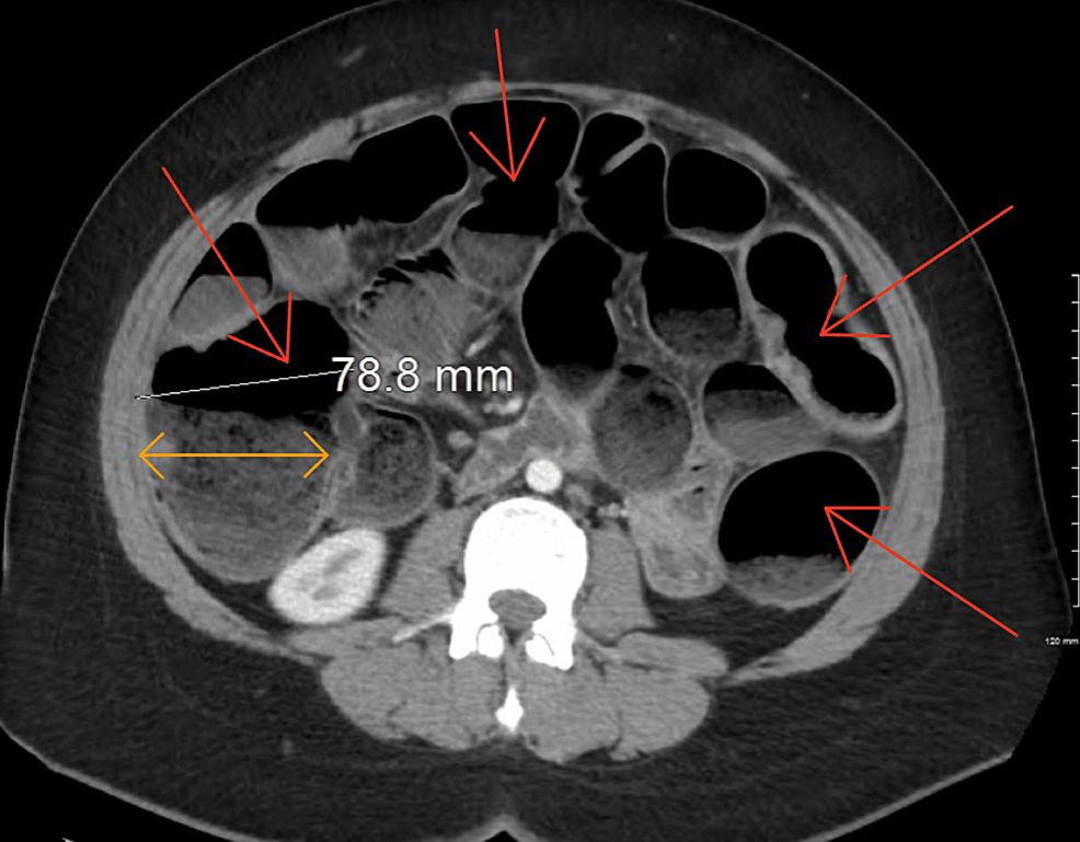 cureus-acute-large-bowel-obstruction-caused-by-endometriosis