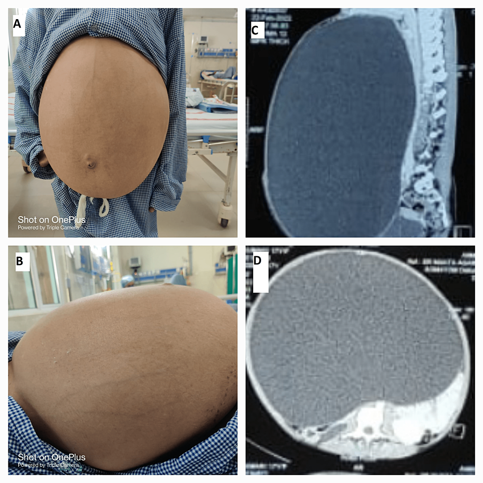 Complete Laparoscopic Ovarian Cystectomy Of Giant Ovarian Serous 