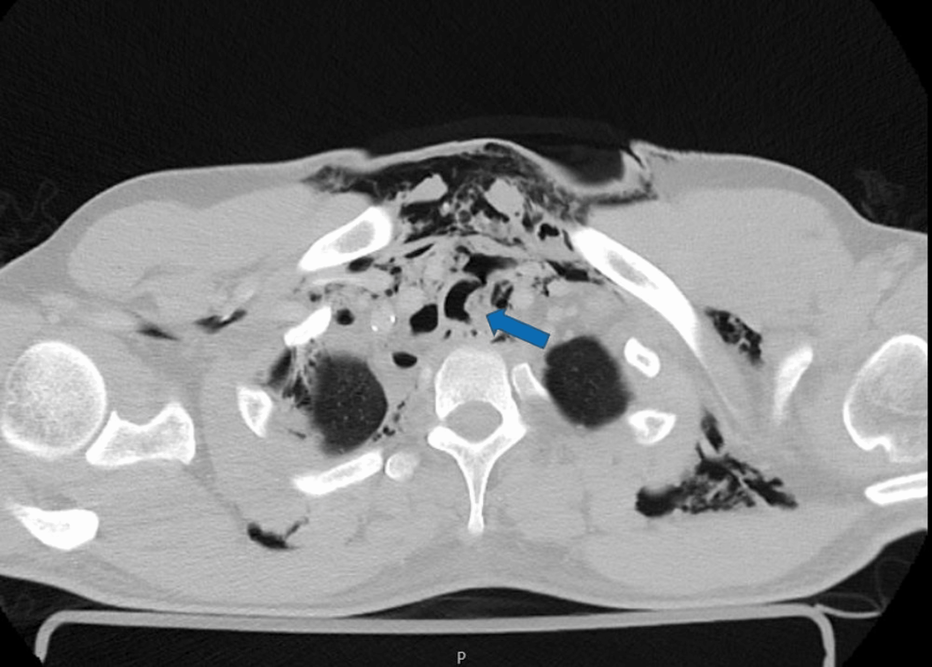 Cureus Tracheal Rupture After Trauma A Successful Conservative