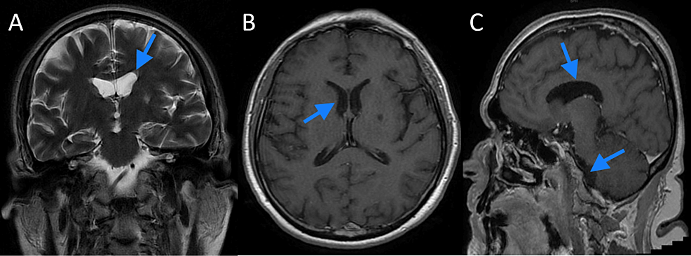 Cranial-magnetic-resonance-imaging-of-the-patient-with-contrast