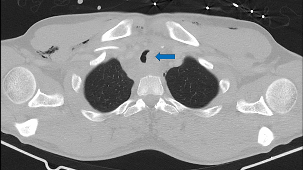 Cureus Tracheal Rupture After Trauma A Successful Conservative
