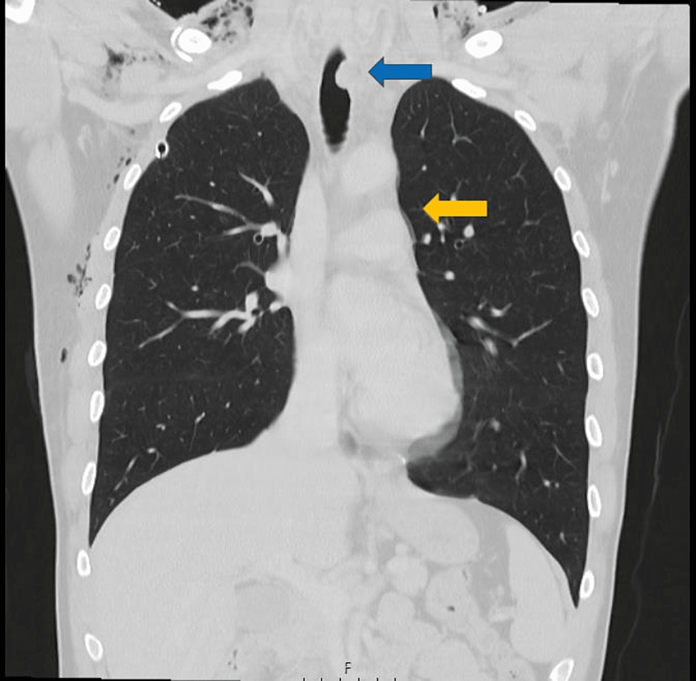 Cureus Tracheal Rupture After Trauma A Successful Conservative