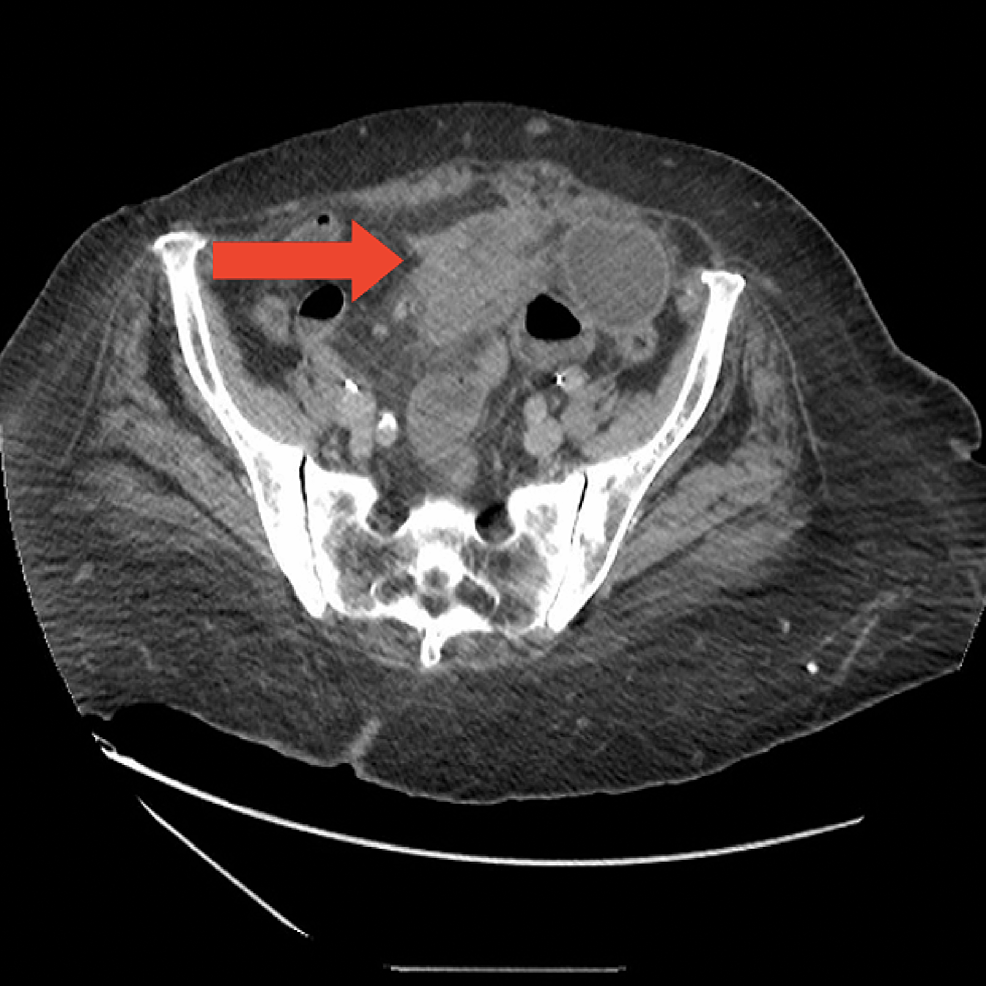 cureus-adenocarcinoma-of-mullerian-origin-presenting-as-small-bowel