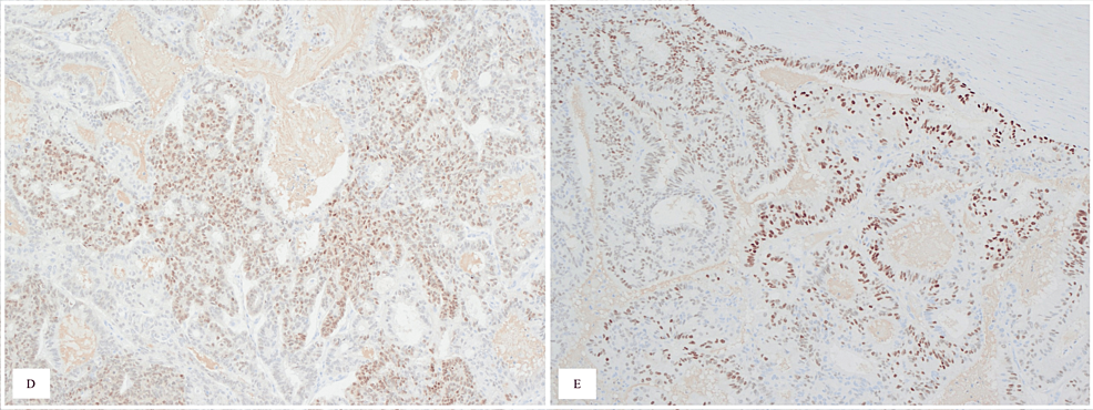 cureus-adenocarcinoma-of-mullerian-origin-presenting-as-small-bowel