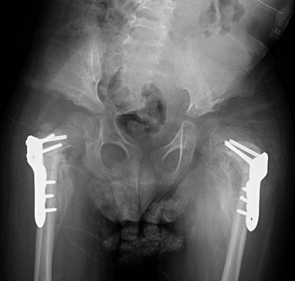 Cureus | Simultaneous Bilateral Proximal Femur Implant Failure: A Case ...