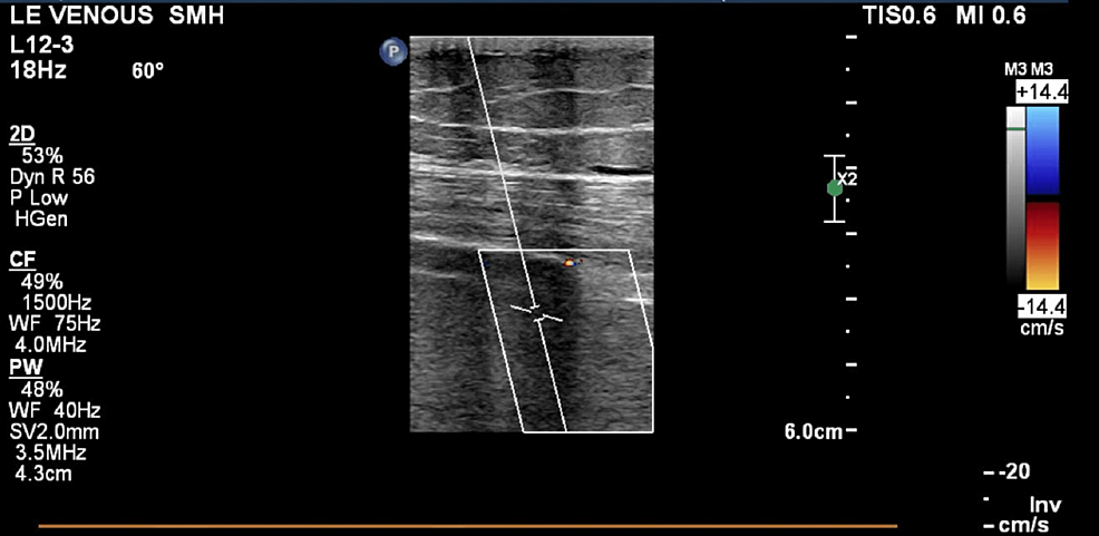 Leg Pain, Swelling Or Varicose Veins Primarily In The Left Leg May Be May  Thurner Syndrone. - Vein Specialists of the Carolinas