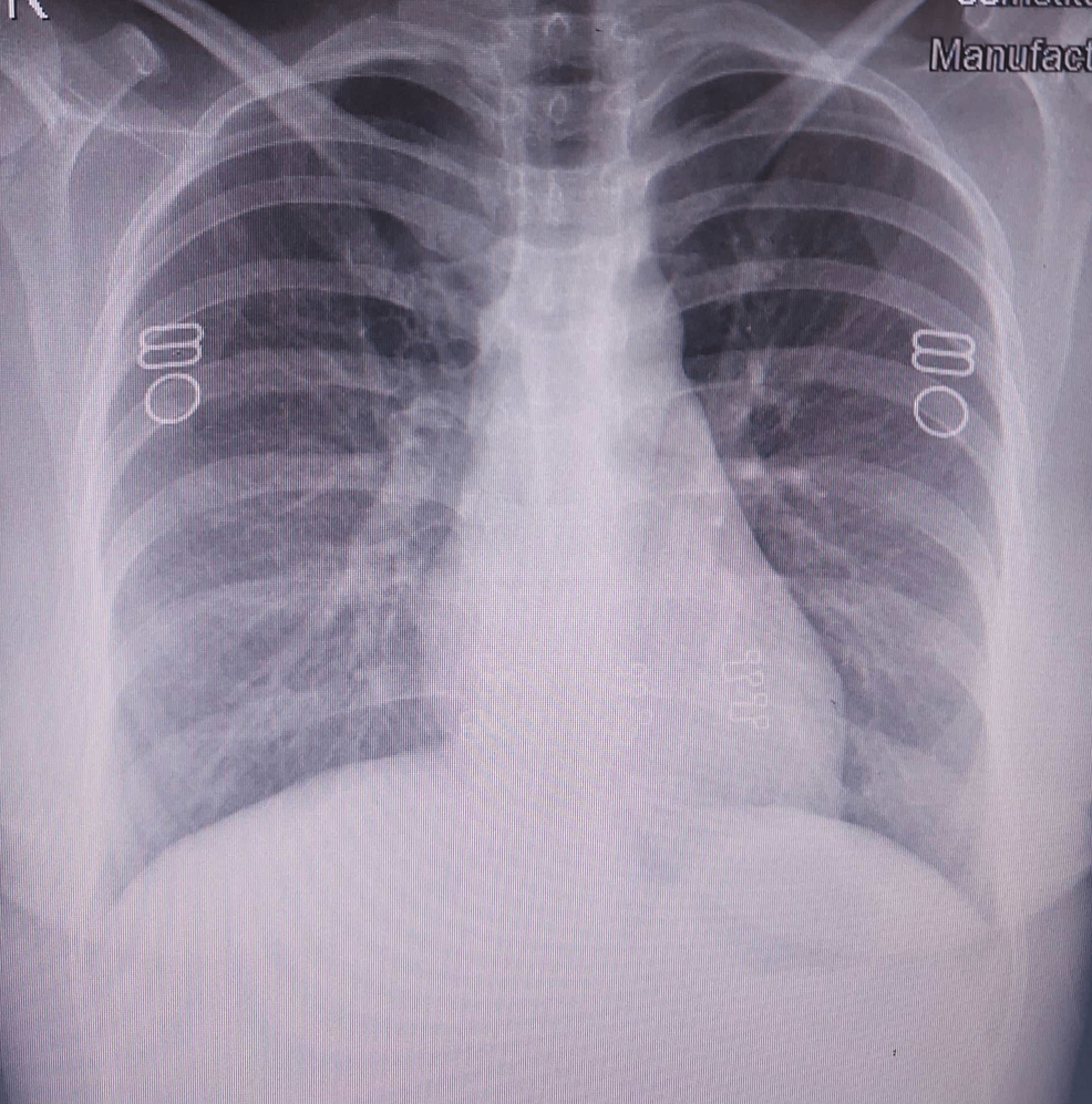 Repeat-chest-radiograph-at-the-time-of-discharge-showing-clear-lung-fields.