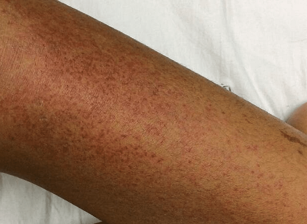 Petechial-spots-on-the-patient's-left-leg.