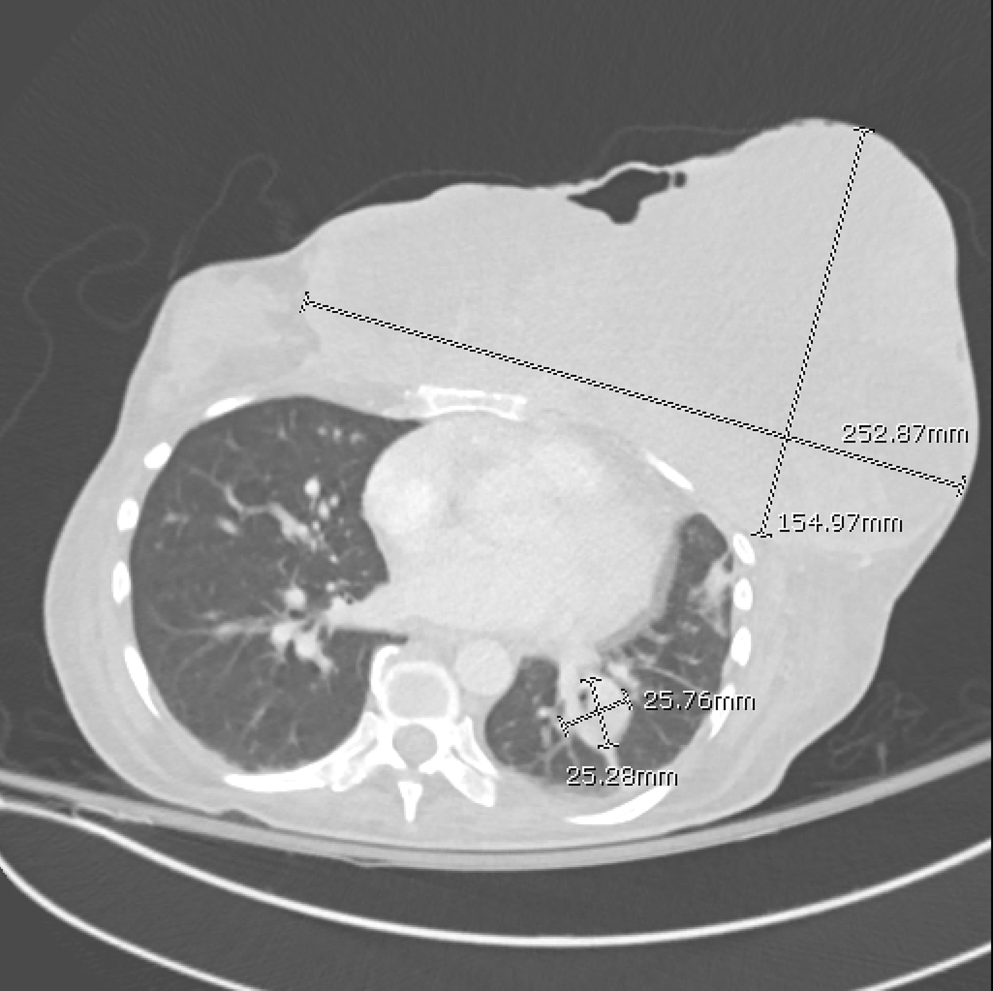 Cureus Debilitating Metastatic Spindle Cell Carcinoma of the Breast