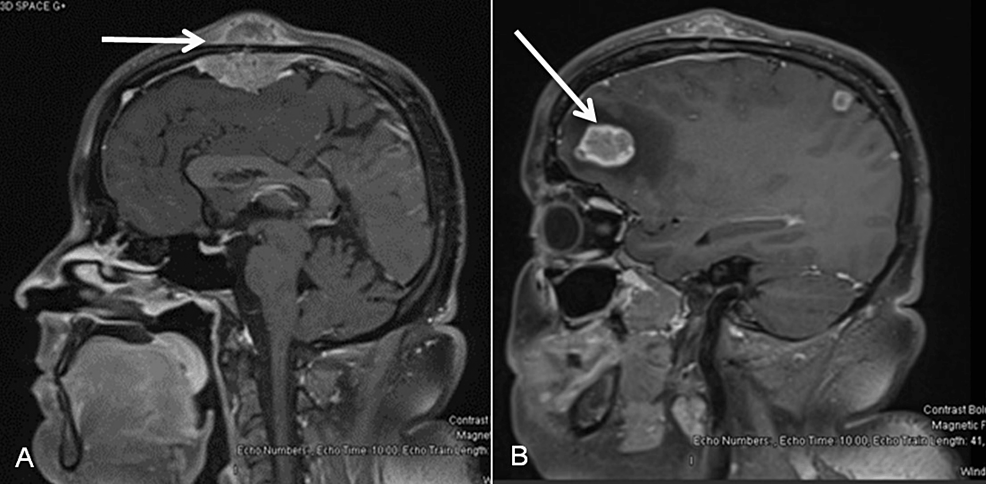 Pre-operative-MRI-of-the-head-sagittal-T1-image-showing-metastatic-lesions.