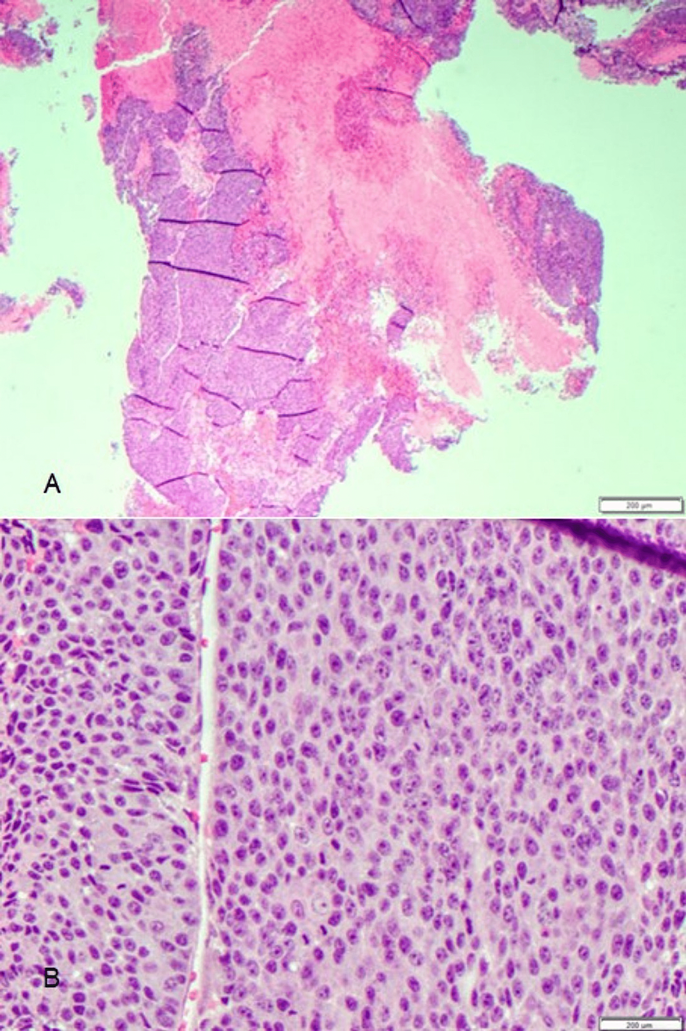 Squamous-cells-from-spinal-tumor-biopsy.