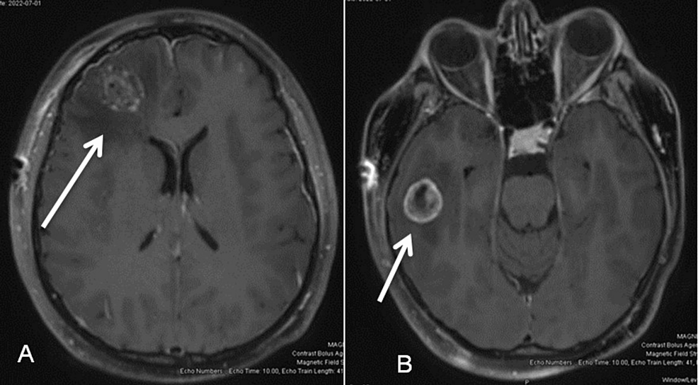 Post-operative-MRI-of-the-patient’s-brain-axial-image-weighted-in-T1-showing-metastatic-lesions.