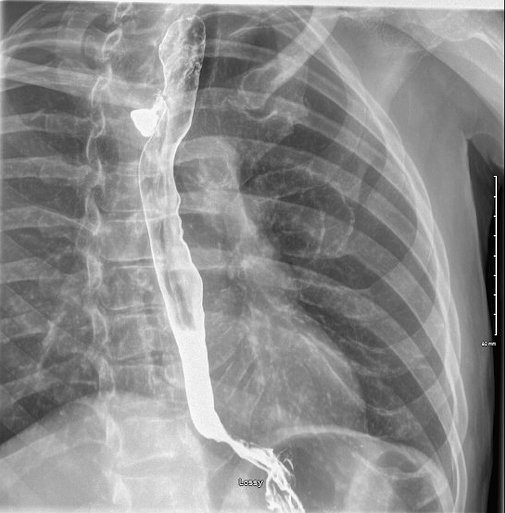 cureus-case-of-tracheoesophageal-fistula-formation-as-a-rare