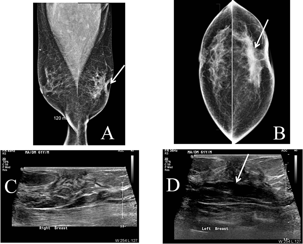 Cureus Female Type Presentation Of Male Breast Cancer In Mammography