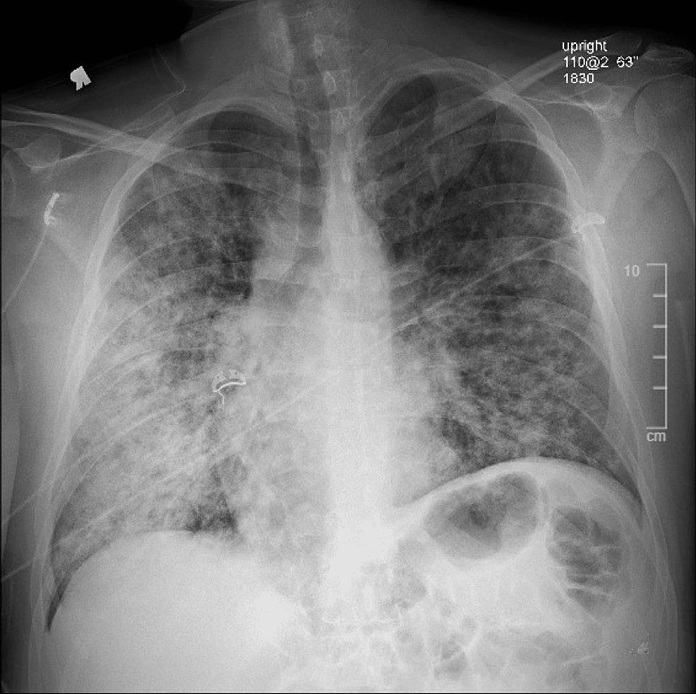 Wyjątkowy przypadek zespołu ostrej niewydolności oddechowej wtórnego do reumatoidalnej choroby płuc po podaniu przeciwnowotworowego czynnika martwicy alfa (TNFα)