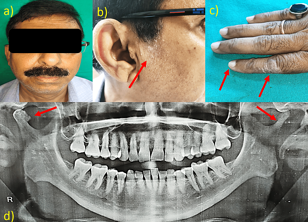a)-No-significant-asymmetry,-b)-presence-of-psoriatic-patch-over-the-facial-region,-c)-involvement-of-nails-and-fingers,-d)-the-panoramic-radiograph-reveals-bony-erosion-with-osteophyte-in-relation-to-the-right-condyle-while-a-sharpened-pencil-appearance-in-relation-to-the-left-TMJ