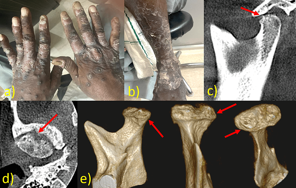 a)-Presence-of-psoriatic-patch-over-hands-and-feet,-b)-oblique-sagittal-section-shows-concave-shaped-remodeling-with-multiple-osteophytes-of-the-superior-surface,-c)-oblique-axial-section-shows-an-osteophyte-in-the-superior-and-anterior-surfaces-along-with-erosion.-d)-3D-CBCT