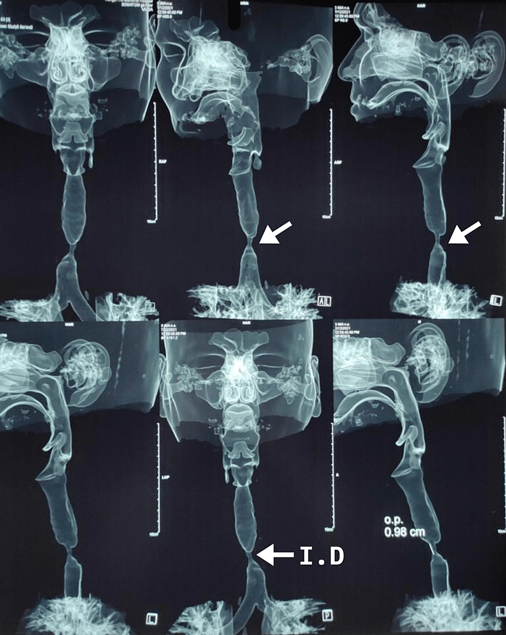 Cureus Achieving Successful Extubation and CostEffective Recovery