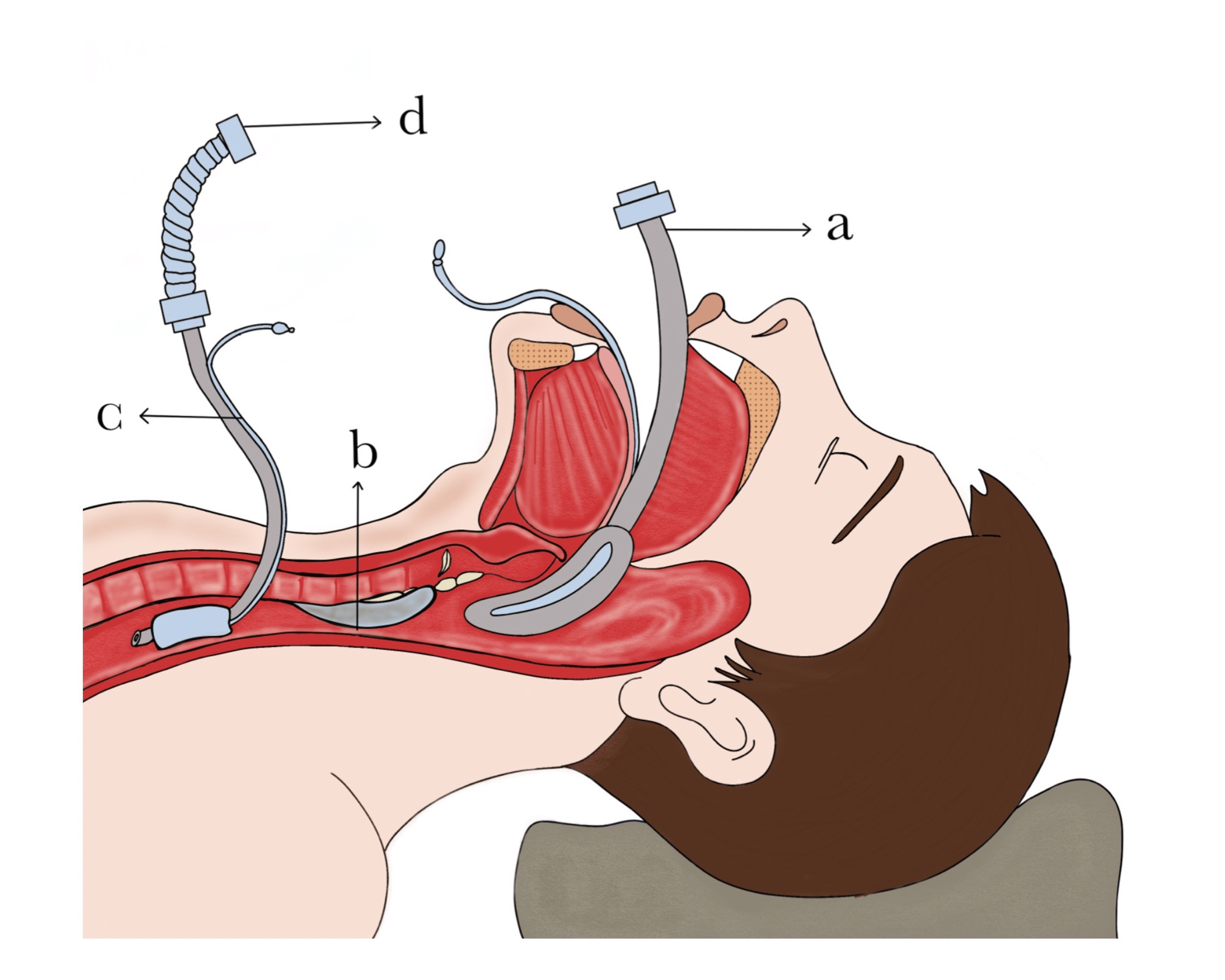 Cureus Achieving Successful Extubation and CostEffective Recovery