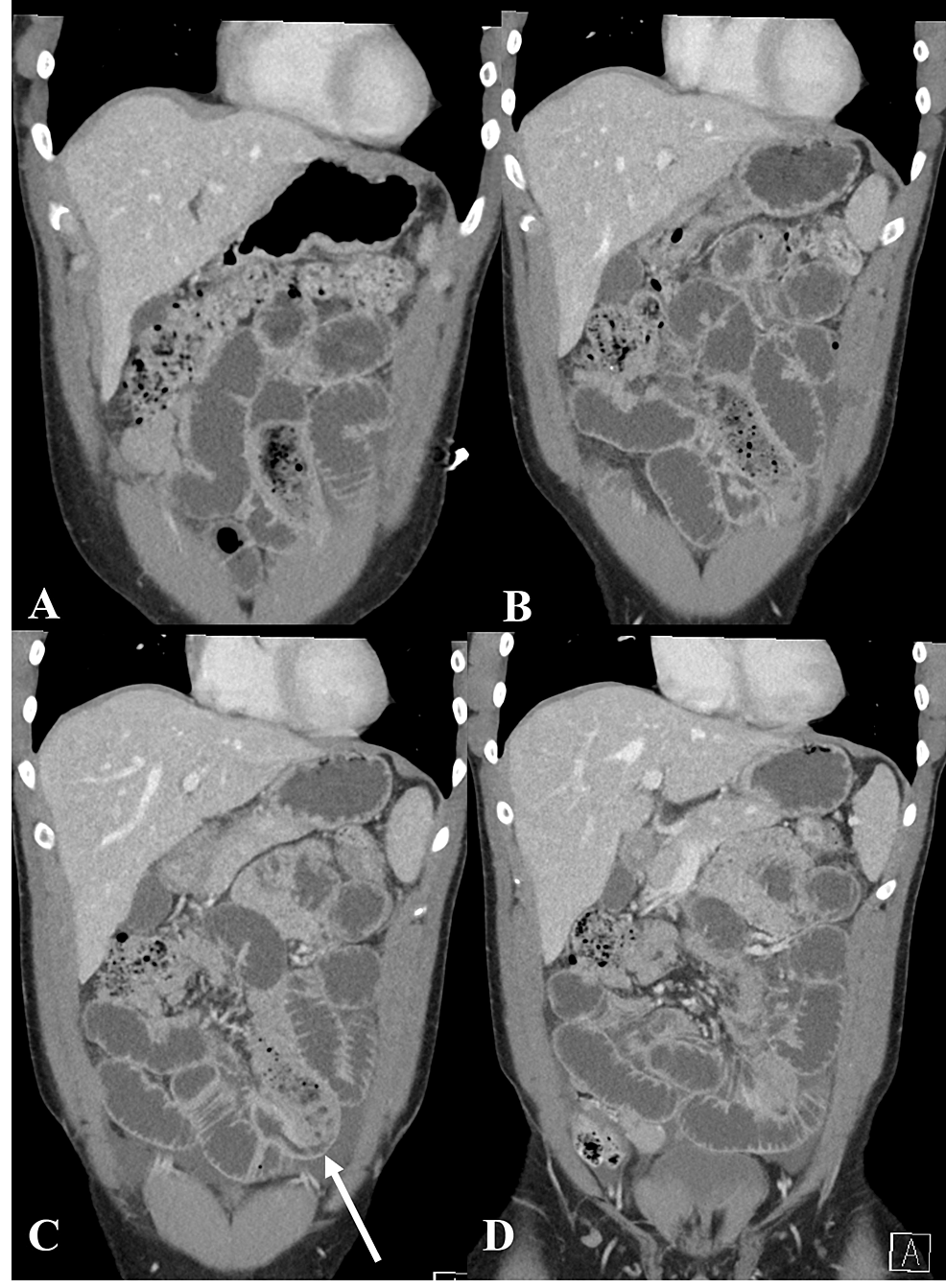 bowel-obstruction-diet-foods-to-eat-and-avoid-fatty-liver-disease