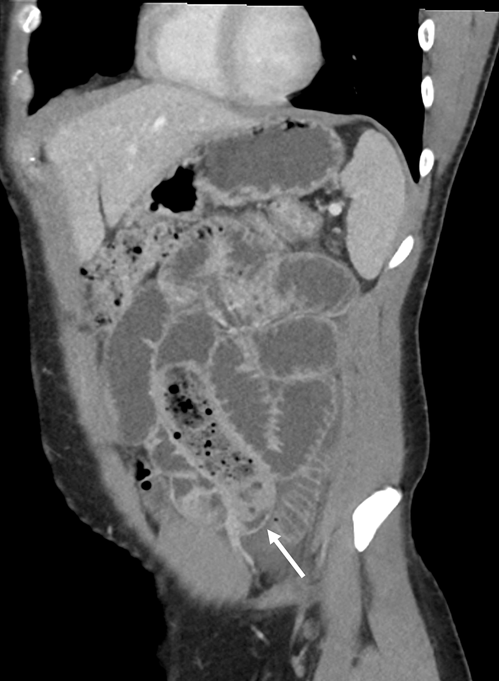 Transition-point-of-the-small-bowel-obstruction.